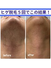 クラリ(Clari)/ヒゲ脱毛/脱毛/メンズ脱毛