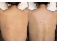 エルピス(ELPIS)/背中Wax