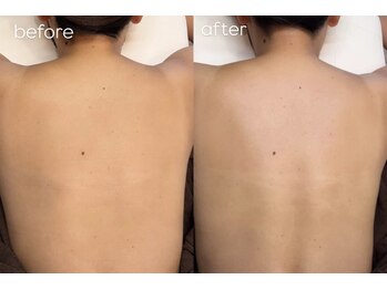 エルピス(ELPIS)/背中Wax