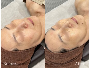 TD 鵜沼店/光フェイシャル