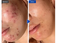 シャルナ(charna)の雰囲気(ニキビ、跡ケア 改善しない症状はありません)