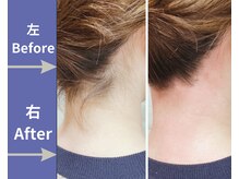 エヌ(N)/ワックス脱毛(うなじ)