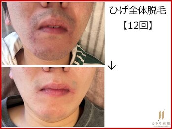 ひかり素肌/ひげ脱毛12回