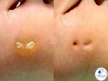 プラスワンフット 本厚木(+1 Foot)の雰囲気（歩くたびに痛みや不快感がある【魚の目】も丁寧にケアします！）