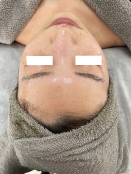 エステサロンブランシュ(Esthe salon Blanche)/ハーブピーリングで艶肌