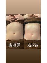 リベル(Liber)/痩身マシンエクシリス【腹部前】