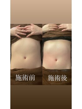 リベル(Liber)/痩身マシンエクシリス【腹部前】