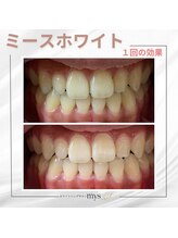 ミースホワイトニング(mys whitening)/ビフォーアフター【歯科提携】