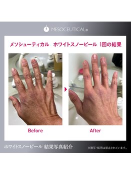 アンジュロワール/手の甲ピールトリートメント