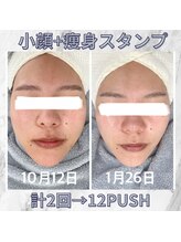 ハロ 南青山(HALO)/小顔スタンプ☆計２回施術