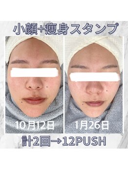 ハロ 南青山(HALO)/小顔スタンプ☆計２回施術