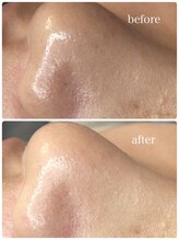 ルウ(Ruu.)/韓国式3D毛穴洗浄