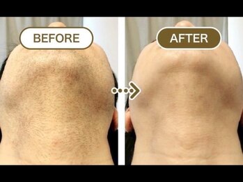 チャッピー(CHAPPY)/メンズ　ヒゲ脱毛