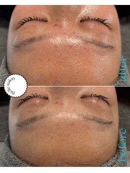 ベルサロン(Belle salon)/ニキビ改善