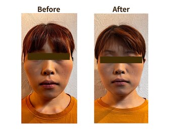 フェルナ(FERNA)/Before/After