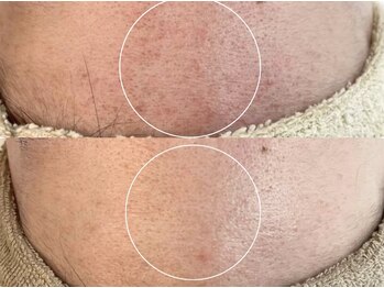 アンベリール(Embellir)/REVIピーリング♪