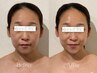 寒暖差で緩むフェイスライン…小顔矯正で切らずに整えてリフトアップ¥15000→