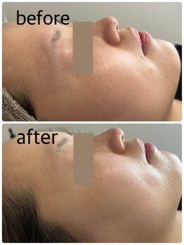 【毛穴洗浄×小顔専門店】 プライベートサロンARCH/美白ケアで水光肌♪