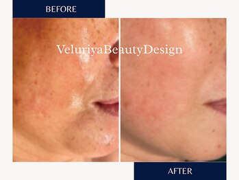 ヴェルーリヤビューティーデザイン(VeluriyaBeautyDesign)の写真/疲れて見えるほうれい線やたるみに、内側から整えて明るく軽やかな印象へ