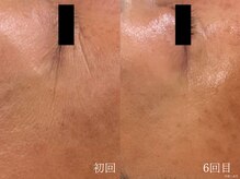 ウォーム(warm)/シワケア/小顔/マッサージ/小顔