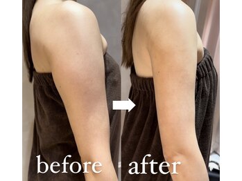 ナルシス(Narcissus)/二の腕before→after