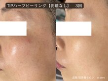 ジュパール(je pars)/TIPハーブピーリング剥離なし