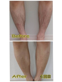 セルフメイド 石巻店/【ビフォーアフター】セルフ脱毛