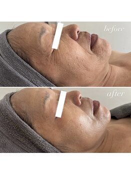 エクラ(eclat)/REVIハーブピーリング