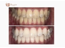 セルフ界最高出力！！歯のホワイトニング☆