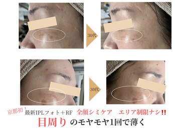 エソア(esoa)/30代 光フォト1回施行→1ヶ月後