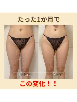 プリア 今治店(Pria)の写真/【頑固な脂肪を撃退！】夏までにサイズダウンしたい方におススメ！理想のボディに♪