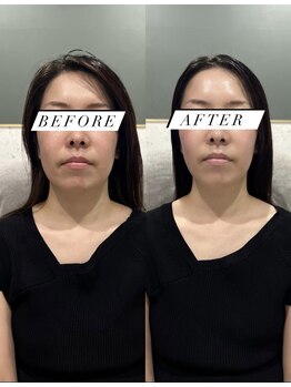 シロ(silo.)/小顔に特化したメニューです