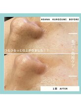 ジュネラ ボーテ(Jenela beaute)/美肌育成　毛穴洗浄