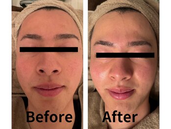 トータルボディケアアンドビューティー タイヨウ(TOTAL BODY CARE&BEAUTY TAIYO)/メンズフェイシャルエステ♪