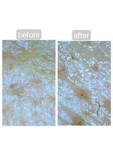 トランク(Trunk)/ハイドラ→プラズマフェイシャル