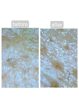 トランク(Trunk)/ハイドラ→プラズマフェイシャル