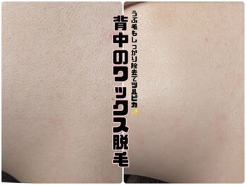 トリニティスペース(TrinitySpace)/背中のワックス脱毛