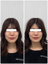 ラフテル鍼灸整骨院/成人式前に小顔矯正×美容鍼♪