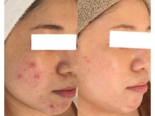 ミベル(MeBell)/【ニキビケア】ハーブリプロ