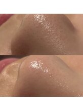 ヨハク 市川店(yohaku)/毛穴洗浄