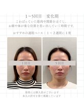 ナツメ鍼灸院(natume鍼灸院)/通い方　１～５回目　変化期