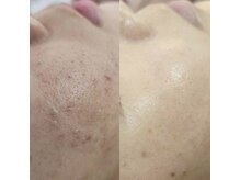 リセラージュ(Recellage)/毛穴洗浄ハイドロフェイシャル