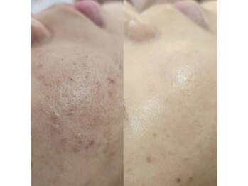 リセラージュ(Recellage)/毛穴洗浄ハイドロフェイシャル