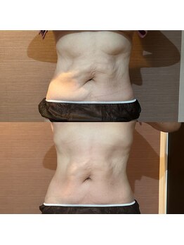 ミーシェ(Me shine)/たるみも引き締めお腹スッキリ!