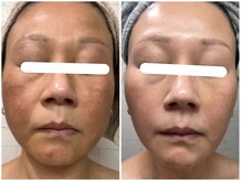 ヴィセラ(Vicella)/50歳 抗酸化化粧品+ラミピール