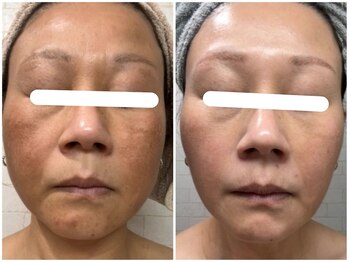 ヴィセラ(Vicella)/50歳 抗酸化化粧品+ラミピール
