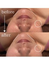 ディースズ(D.suzu)/白玉リフティングbefore/after