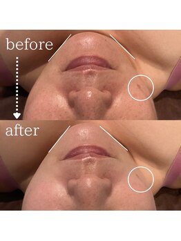 ディースズ(D.suzu)/白玉リフティングbefore/after