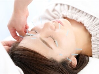 ビハリーズ(BEHARRYS)の写真/【リフトアップやたるみ改善に◎】話題の美容鍼で速攻小顔！初回¥3500で初めての方もお気軽に施術が可能☆