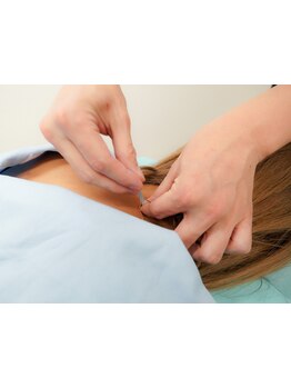 鍼灸施術を受けたい